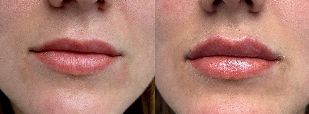 Lip Fillers Before and After