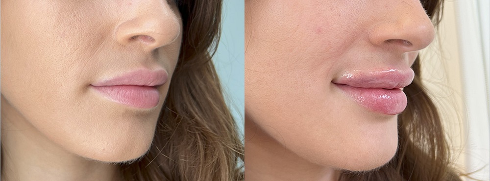 Lip Fillers Before and After
