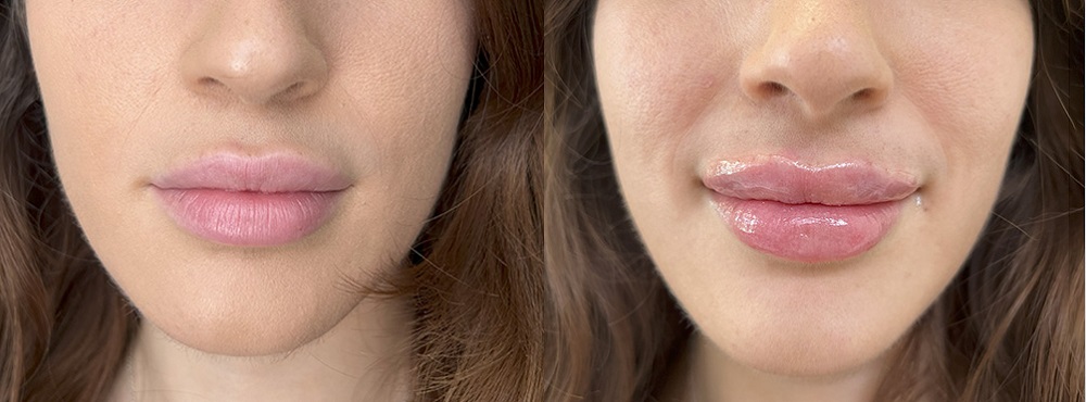 Lip Fillers Before and After