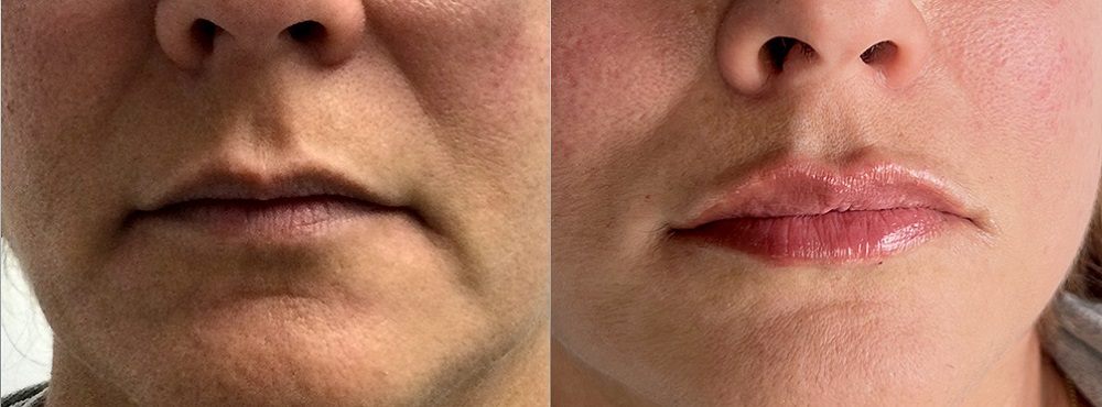 Lip Fillers Before and After