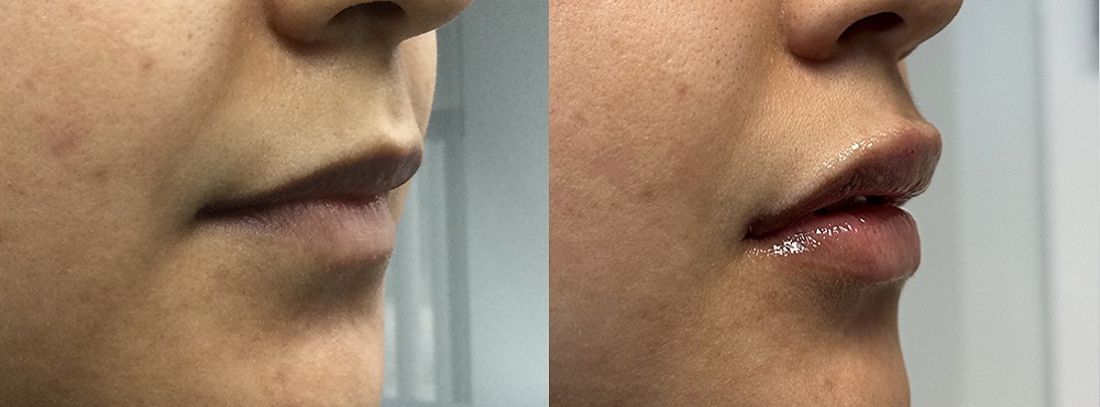 Lip Fillers Before and After