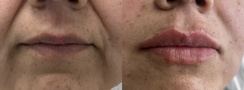 Lip Fillers Before and After