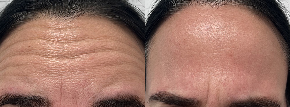 Botox Before and After