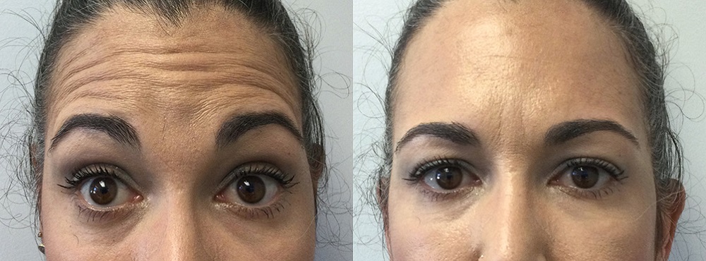 Botox Before and After