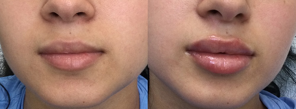 Lip Fillers Before and After