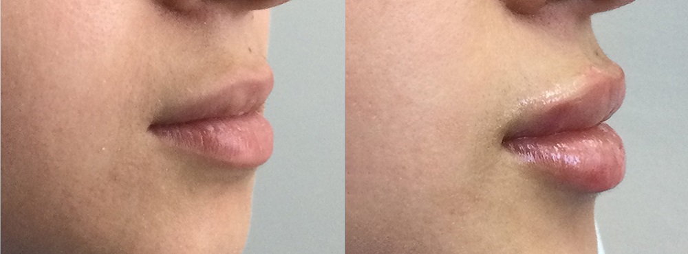 Lip Fillers Before and After