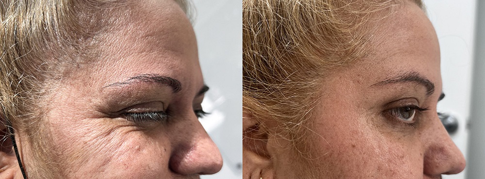 Botox Before and After