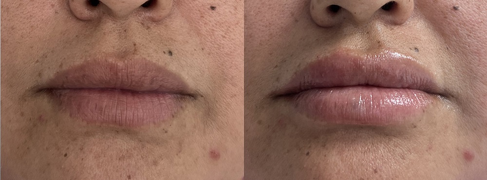 Lip Fillers Before and After