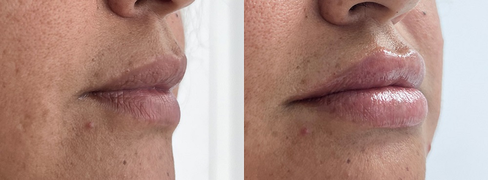 Lip Fillers Before and After