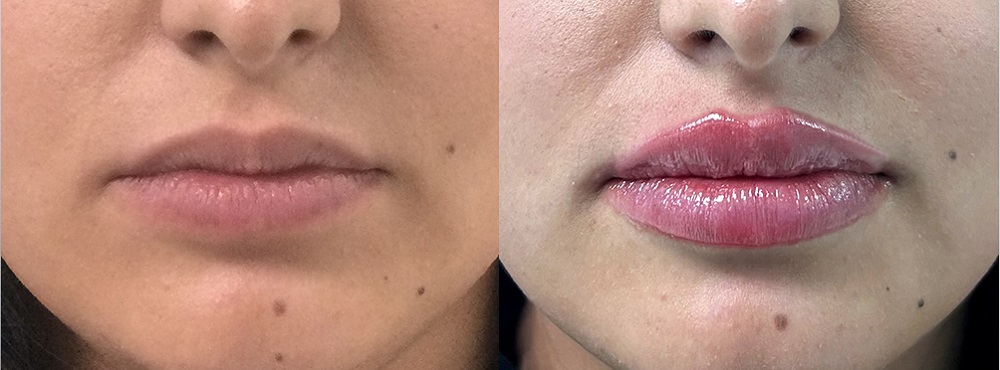 Lip Fillers Before and After