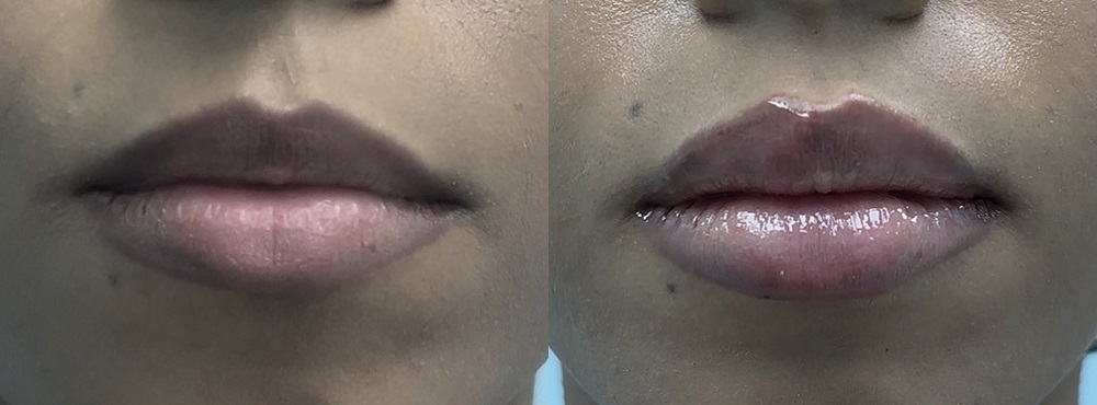 Lip Fillers Before and After