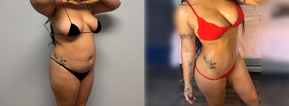 Brazilian Butt LIft Before and After