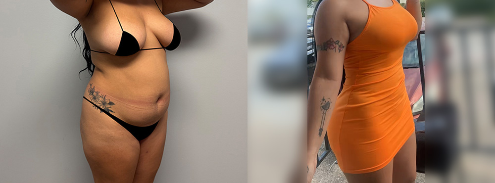 Brazilian Butt LIft Before and After