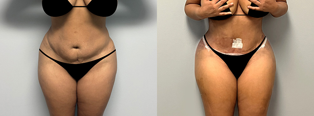 Tummy Tuck Before and After