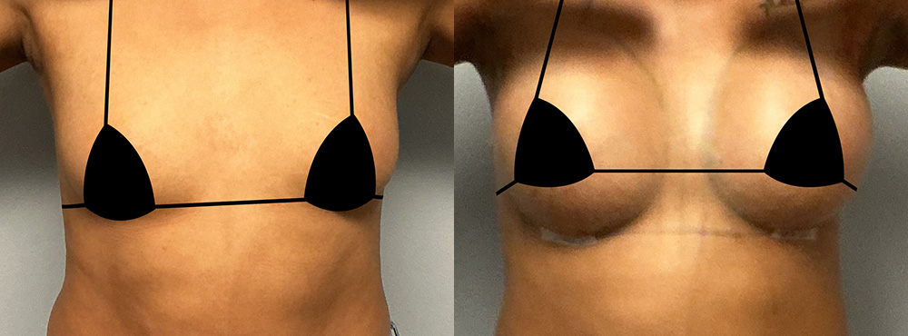 Breast Augmentation Before and After