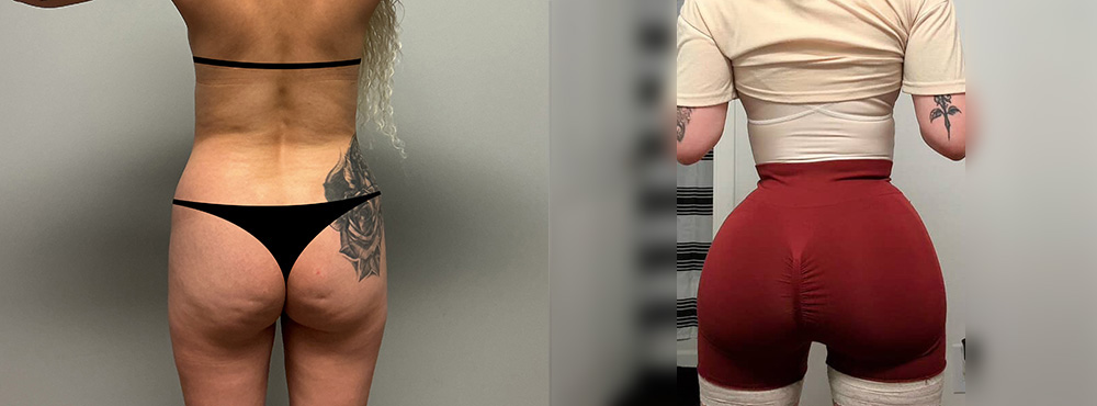 Brazilian Butt Lift Before and After