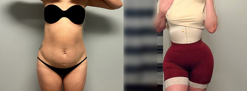 Brazilian Butt Lift Before and After