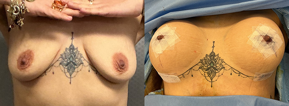Breast Augmentation Before and After