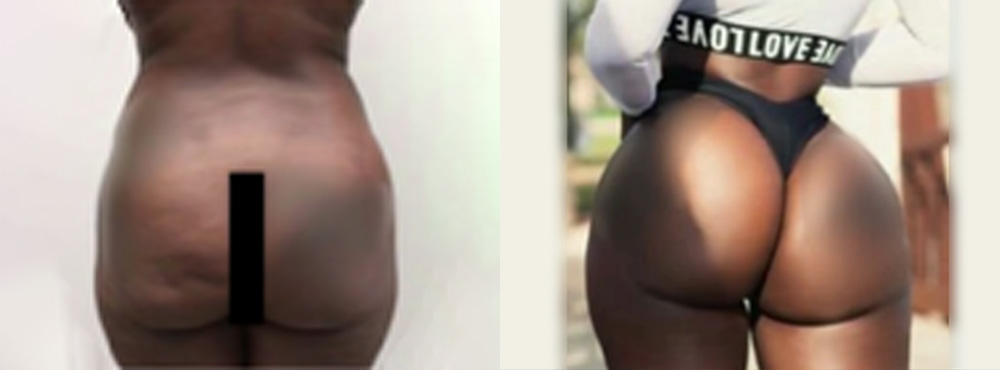 Brazilian Butt Lift Before and After