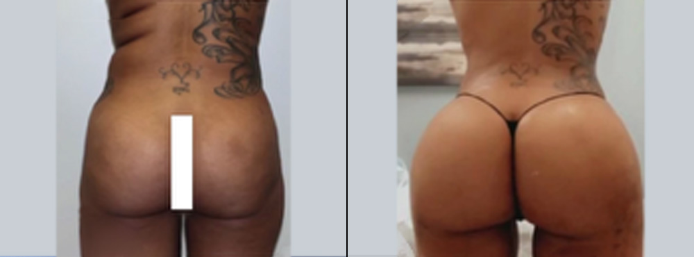 Butt Lift Before and After