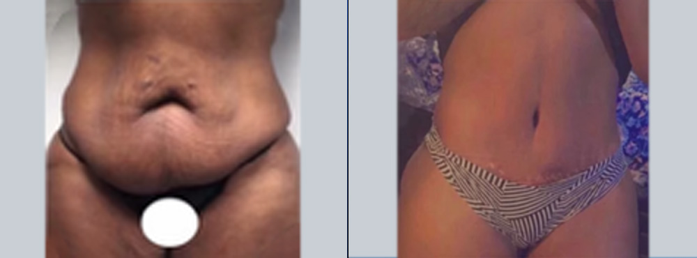 Tummy Tuck Before and After