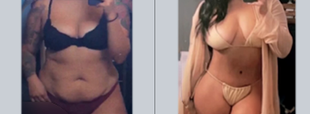 Tummy Tuck Before and After