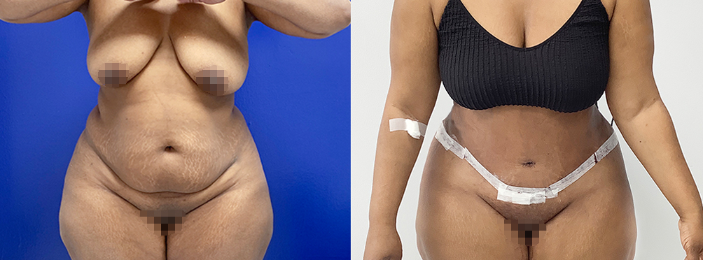 Tummy Tuck Before and After