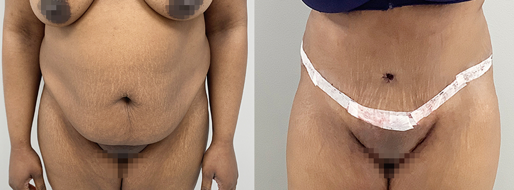 Tummy Tuck Before and After