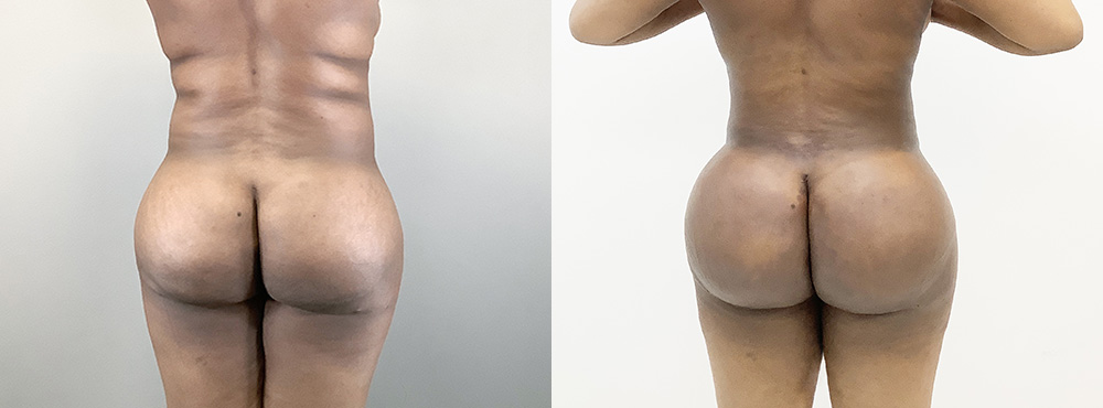 BBL Before and After