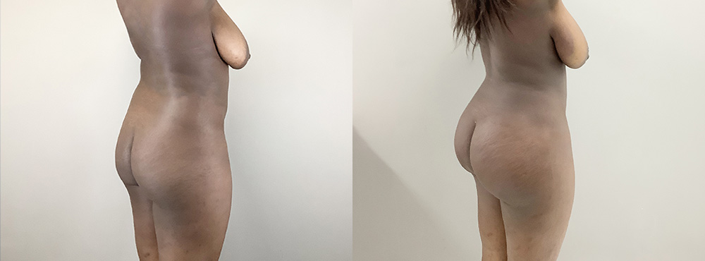 BBL Before and After