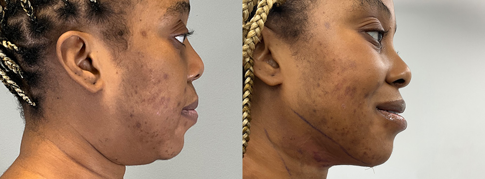 Chin Liposuction Before and After