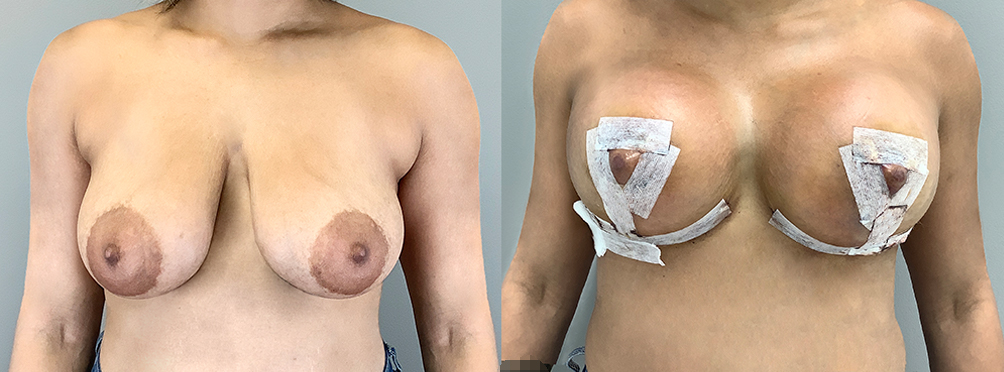 Breast Lift Before and After