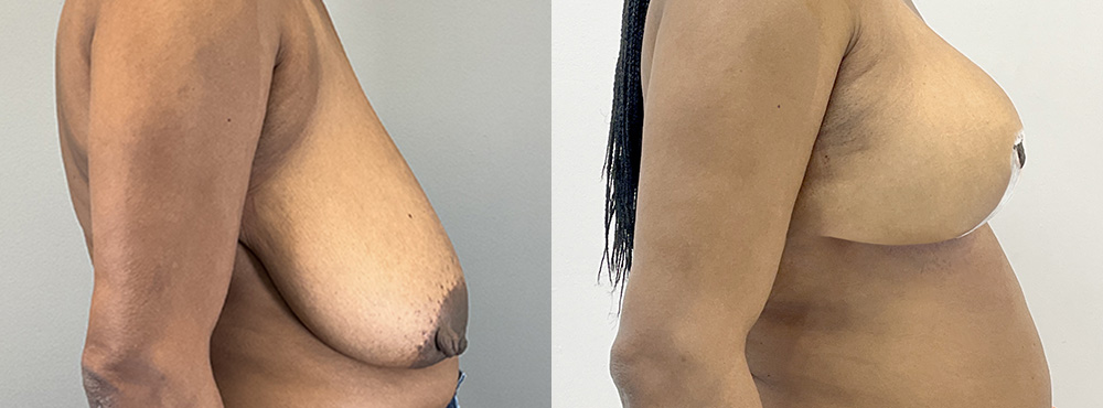 Breast Lift Before and After