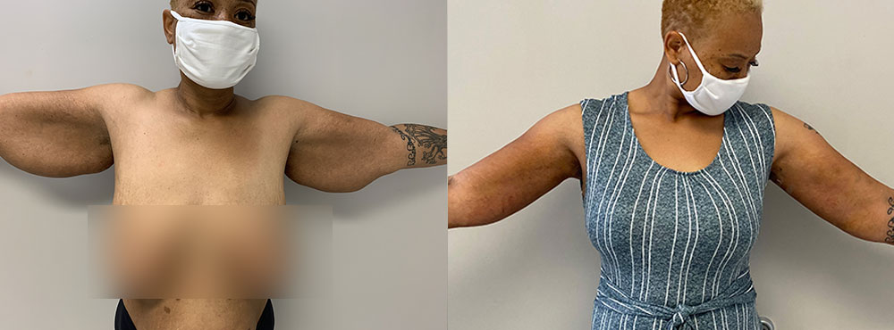 Arm Lift Surgery before and after