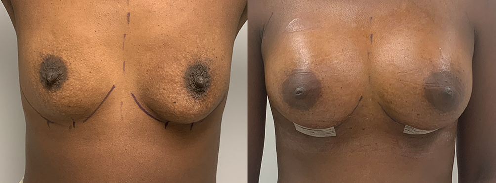 Breast Augmentation Before and After