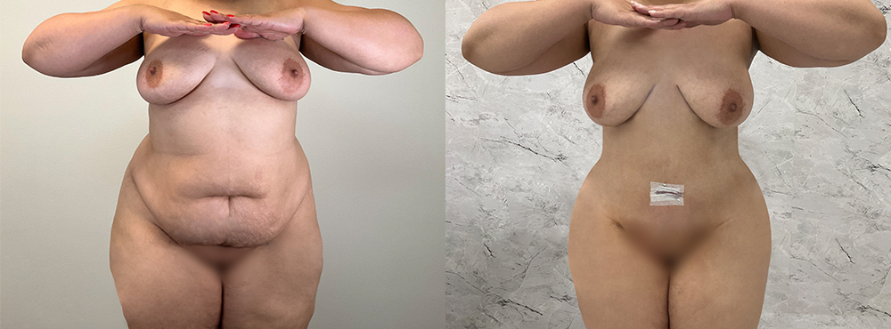 Tummy Tuck Before and After