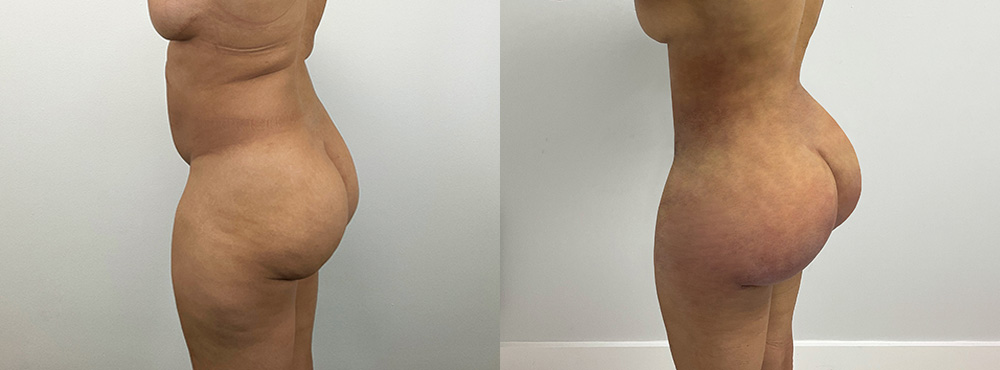 BBL Before and After