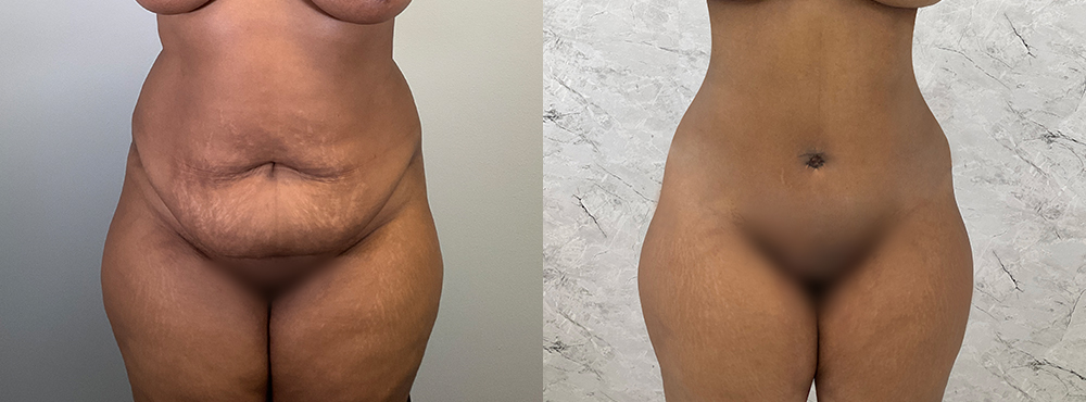 Tummy Tuck Before and After