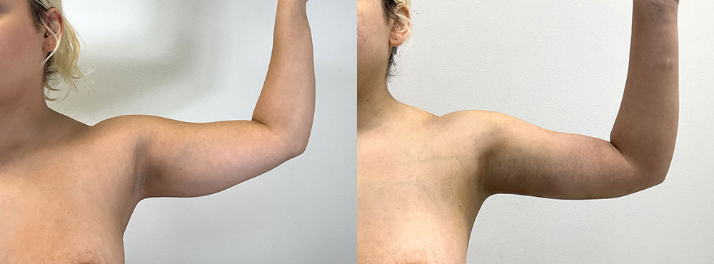 Arm Liposuction Before and After