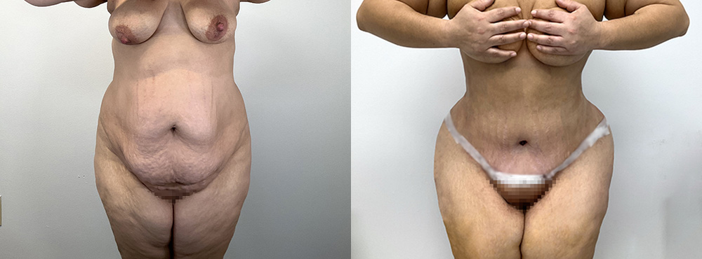Tummy Tuck Before and After