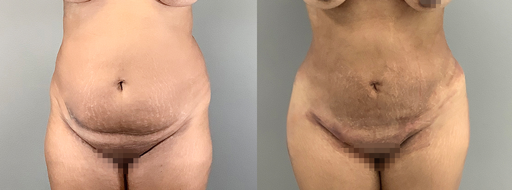 Brazilian Butt Lift Before and After