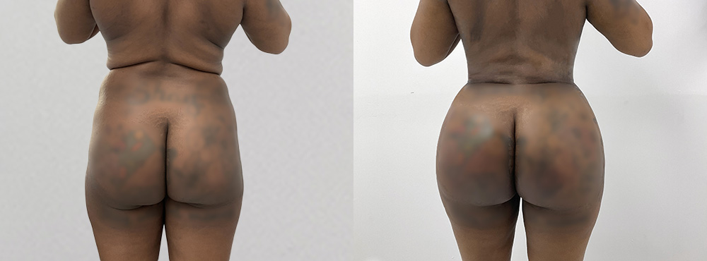 BBL Before and After