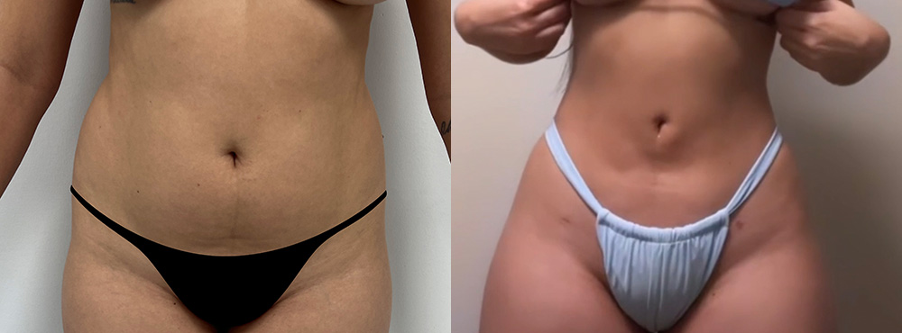 Lipo 360 Before and After