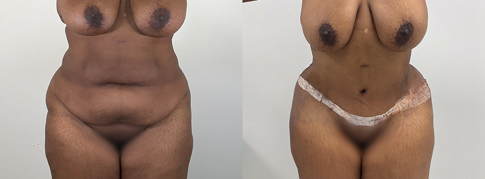 Tummy Tuck Before and After