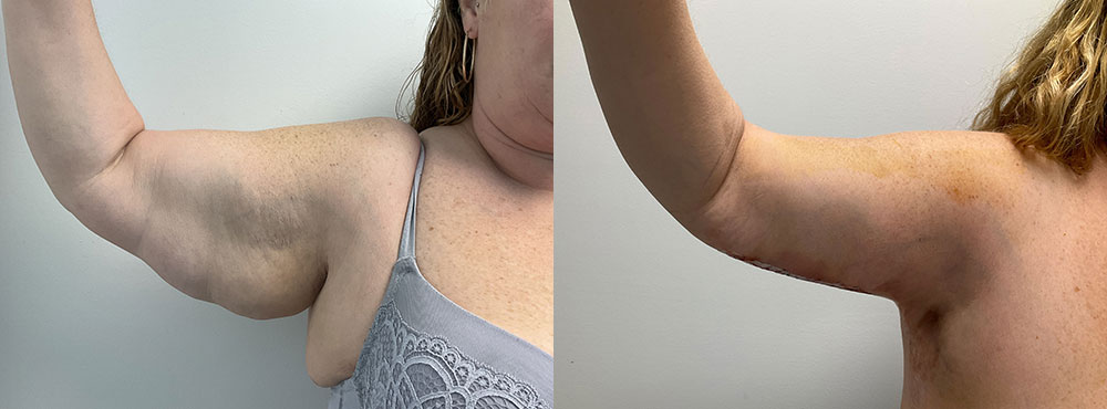 Arm Lift Miami Before And After