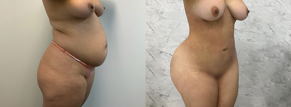 BBL Before and After