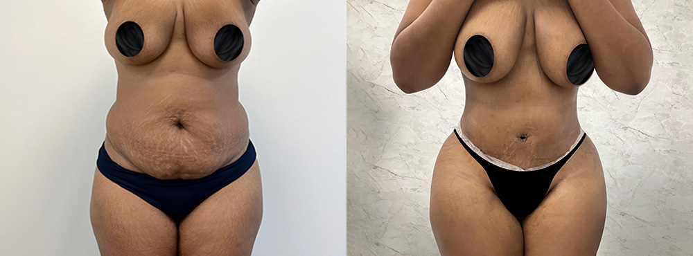 Mommy Makeover Before And After in Miami