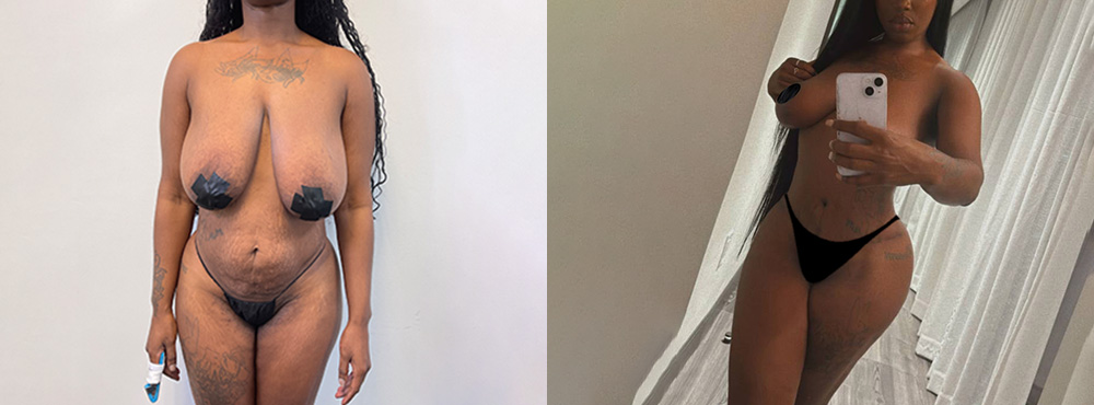 Mommy Makeover Before and After