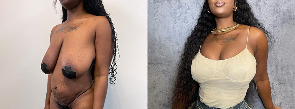 Mommy Makeover Before and After