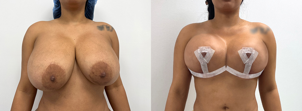 Breast Lift Before and After